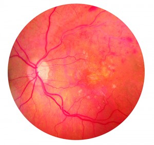 Retinal Vein Occlusions