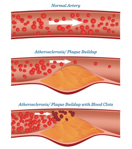 atherosclerosis